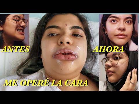 Vlog #2: Vale la pena? 😱 18 días POST OP | Todo sobre mi Cirugía Ortognática Clase III | Chile