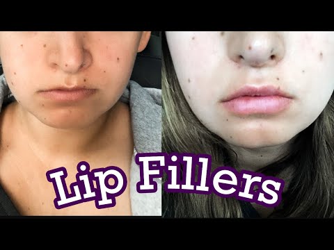 My Lip Filler Experience (WITH PICTURES)!