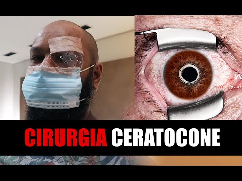 DIÁRIO DE CIRURGIA DE CERATOCONE | ANTES E DEPOIS