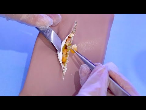 ASMR RETIRADA DE PEDRA NO RIM (cirurgia)
