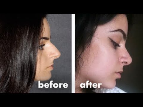 My Nosejob Experience | Nymfy Official