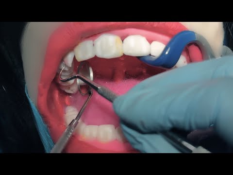 ASMR Dental Exam 🦷 Scaling & Cavities | Dentist & Patient POV