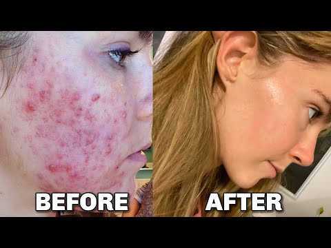 How To Get Clear Skin FAST - PRIVATE COACHING - (Last Day To Register)