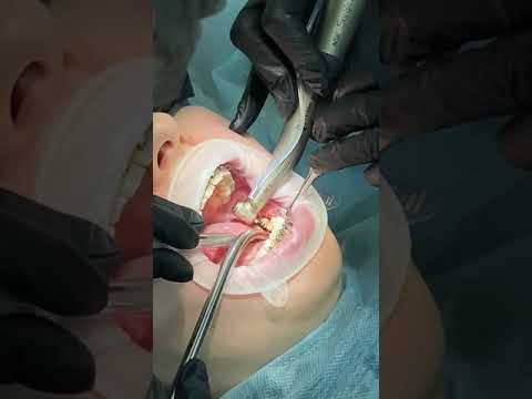 😸 My tooth implantation process.
