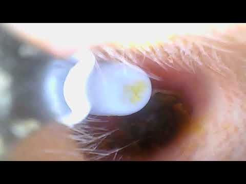 a really disgusting Video! cleaning my ears massive earwax!