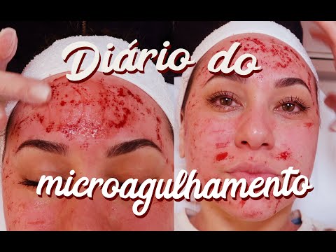 DIÁRIO DO MICROAGULHAMENTO #2 |ADEUS MELASMA! - DERMAROLLER