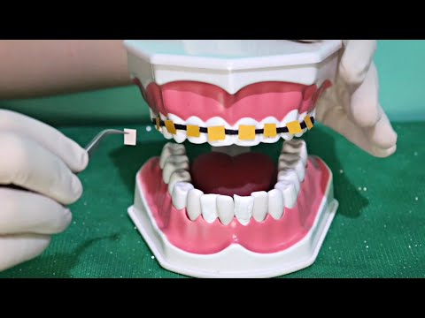 ASMR : COLOCANDO APARELHO NOS DENTES (aparelho odontológico)