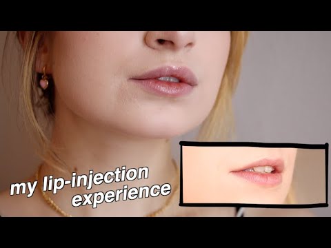 I Got Lip Injections! Before & After Experience