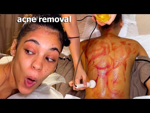 ASMR: Relaxing BACK ACNE Removal Treatment!