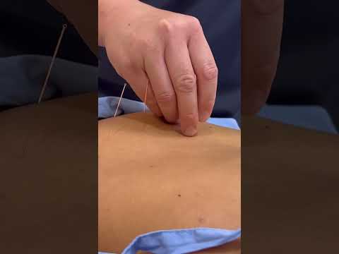 ASMR: Relaxing Chinese Tuina Massage and Acupuncture #shorts