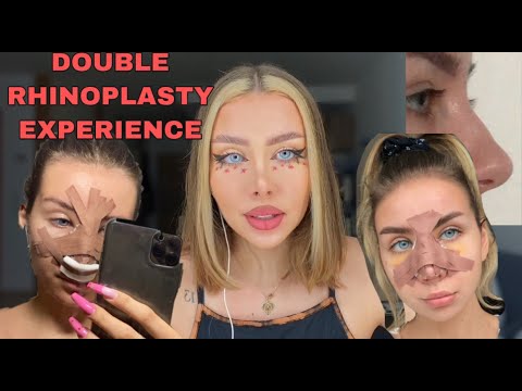 MY NOSE JOB EXPERIENCE - two rhinoplasties at 18