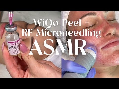 RELAXING ASMR! WiQo Peel + RF Microneedling for Scarring & Acne