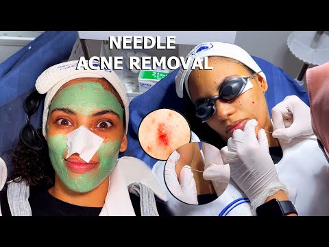 ASMR: I Tried ACNE REMOVAL with NEEDLES!