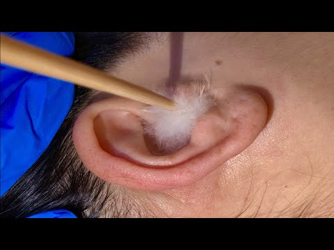 ASMR Ear Cleaning *UP CLOSE* w. Various Ear Picks, Qtips, Crinkly Gloves + REMOVING STICKY EARWAX!!