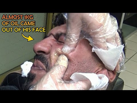 ALMOST 1KG OF OIL CAME OUT OF HIS FACE + EAR BURN AND WAX + CRACKS + Asmr head,face,neck,ear massage