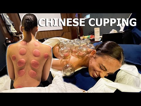 ASMR: Relaxing FIRE CUPPING Back Massage!