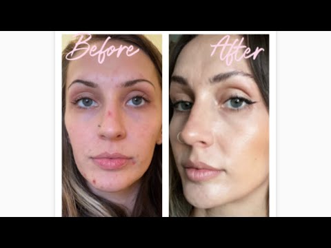 Talking To You About My Skin (& how I fixed it!)ASMR