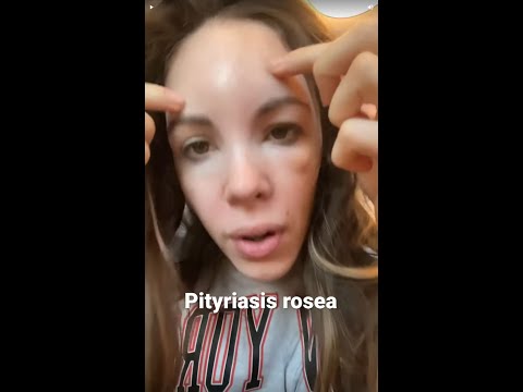 Swollen Face & Rash ALL OVER (Pityriasis rosea)