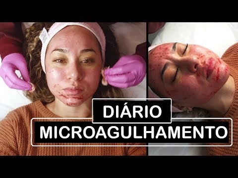DIÁRIO DO MICROAGULHAMENTO |ADEUS MELASMA! - DERMAROLLER