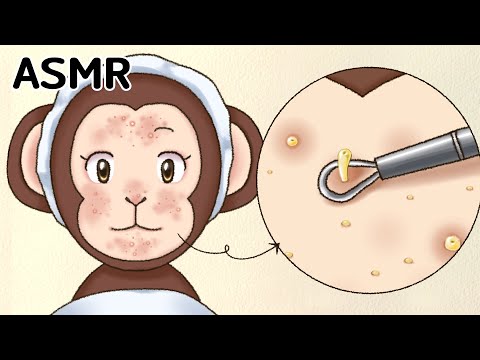 ASMR 케어 애니메이션 쾌감 주의 ✨몽희의 여드름 피부 관리 | 속이 시원한 여드름 압출 | Acne Removal Skin Care | Acne extract