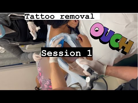tattoo removal before and after [session 1 #picosure #tattoo