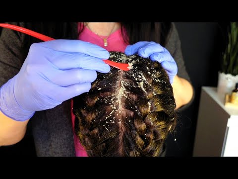 ASMR Satisfying Dandruff Removal | Perfectionist Doctor | Scalp Check with Bad Results (Whispered)