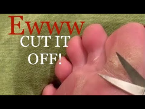 Asmr My Weird Toe Callous Removal (Do NOT watch if easily grossed out, especially towards the end)