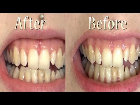 Teeth Whitening Review: Charwhite Powder & BlackWood Tooth Paste