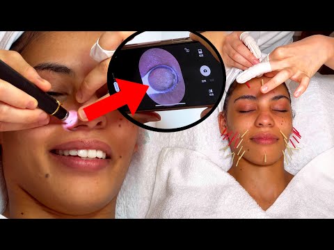 ASMR: Relaxing Chinese Facial Acupuncture with ACNE Removal!