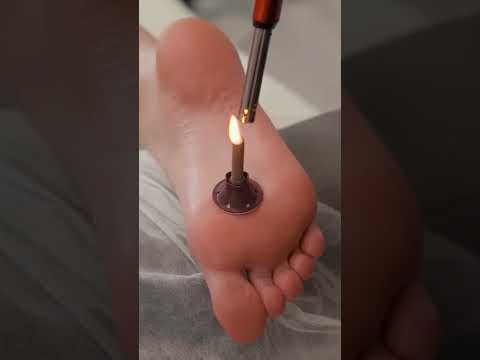 Moxibustion and Foot Warming with Artemisia Cigar for Healing