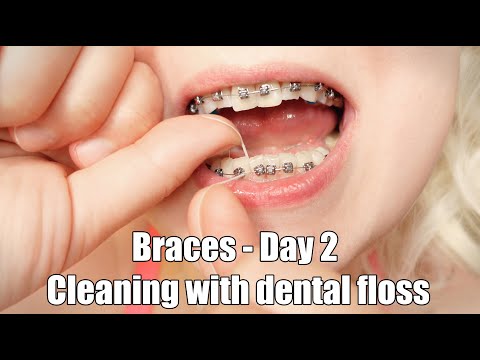 2nd day braces - cleaning with dentalfloss
