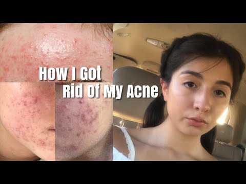 How I Got Rid Of My Acne