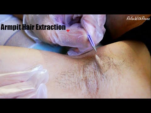 ASMR Hair Removal REAL PERSON (Armpit Edition) w. Tweezers, Gloves, Sticky Tape, Spray Bottle Sounds