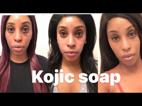 how to get rid of hyperpigmentation with Kojic soap