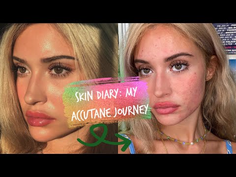 my skin diary | my FIVE experiences on ACCUTANE/ISOTRETINOIN (ep. 4)