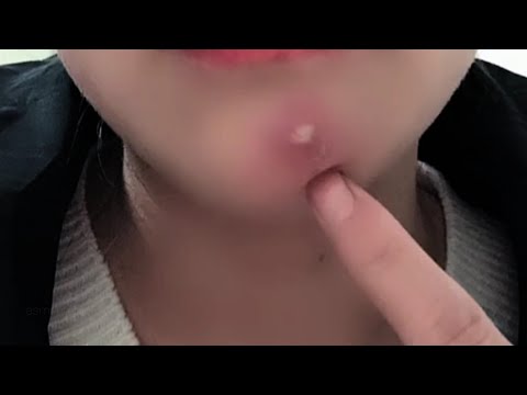 asmr - up close pimple popping