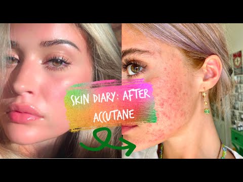 my skin diary | ep 1 (spironolactone failed, the ordinary broke me out, + starting from square one)