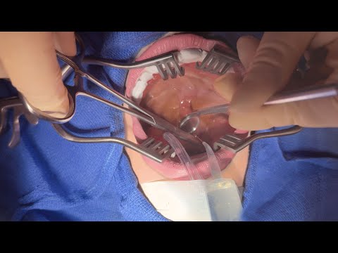 ASMR Surgery Tonsillectomy | Doctor & Patient POV | Post-Op Cranial Nerve Exam