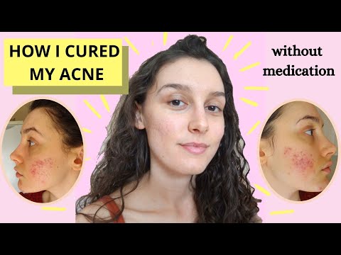 HOW TO CURE ACNE (without medication) /eng subtitles/
