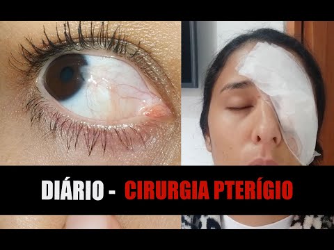 DIÁRIO DE CIRURGIA DO PTERÍGIO  DE UMA SEGUIDORA | ANTES E DEPOIS