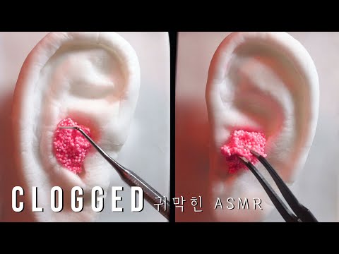 ASMR 🎧 Ear Cleaning : clogged with Foam Clay (No Talking)