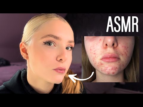 [ASMR FR] Mon Histoire Avec L'acné.