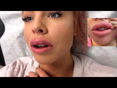 MY BOTCHED Lip Injection Nightmare - WARNING GRAPHIC CONTENT - ASMR