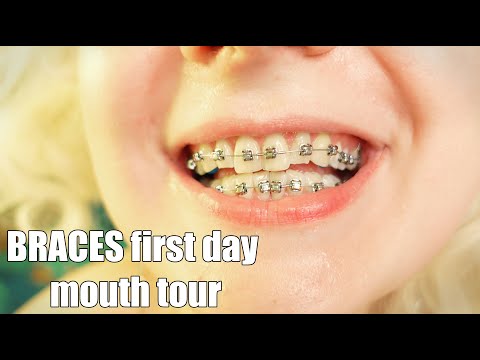 BRACES first day mouth tour close up!