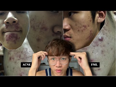 MY SEVERE ACNE JOURNEY AND HOW I "CLEARED" IT ( WITH MANY PICTURES) not asmr