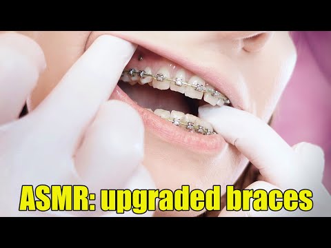 ASMR: upgraded braces with chain-link rubber bands and nitrile gloves