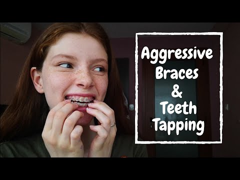ASMR | Aggressive Teeth & Braces Tapping + Scratching