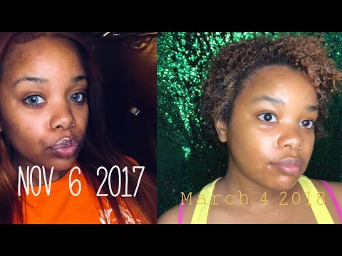 WITCH HAZEL & OXY PADS | 28 Day Challenge 💖