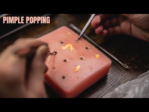 ASMR - PIMPLE POPPING! (Very satisfying & relaxing sounds)